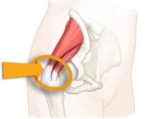 Тендинит коленных связок. Тендинит сухожилия тазобедренного сустава. Тендинит сухожилий ягодичных мышц. Тендинит сухожилий ягодичных мышц тазобедренных суставов. Тендинит сухожилия надколенника.